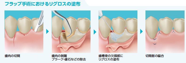 リグロスの手術術式