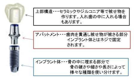 インプラントの構造