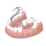 取り外しの入れ歯による治療